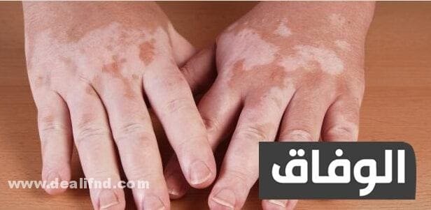 الفرق بين البقع البيضاء والبهاق