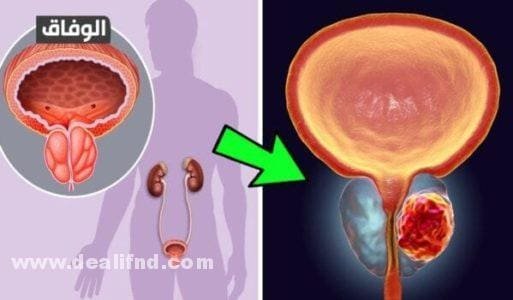 +06 أفضل وأقوى مضاد حيوي لعلاج التهاب البروستاتا نهائيا 2026 افضل مضاد حيوي لعلاج التهاب البروستاتا