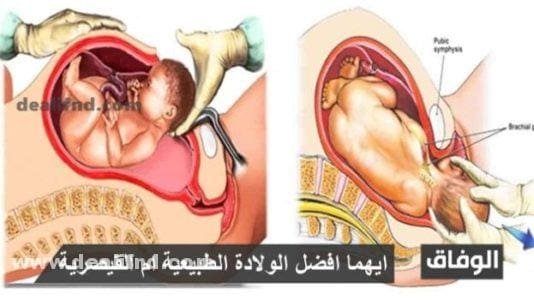 ايهما افضل الولادة الطبيعية ام القيصرية 2024