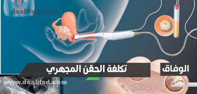 كم تكلفة الحقن المجهري ونصائح للمرأة قبل إجراء الحقن المجهري بشهر