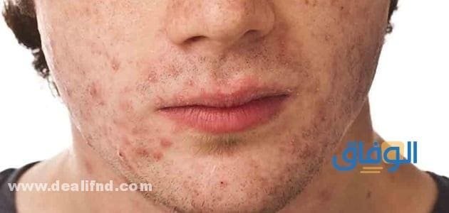 02 من اقوي (وأفضل غسول للبشرة الدهنية للرجال) وطريقة استخدامه