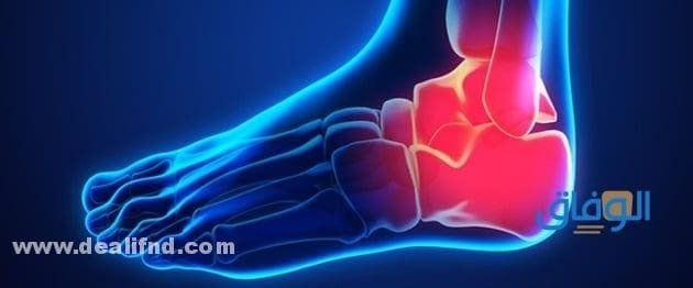 أهم أعراض وعلاج (دبابيس في كعب الرجل)