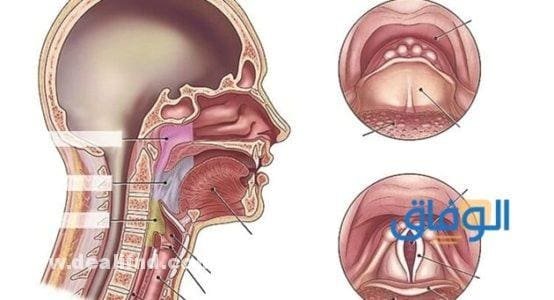 علاج التهاب الحلق والاذن