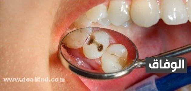 علاج الضرس المحفور وأهمية هذه العمليىة في علاج الأسنان علاج الضرس المحفور