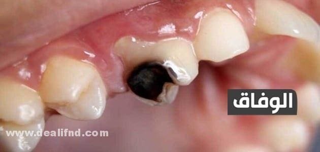 علاج ضرسي محفور ويوجعني في البيت | راحة فورية ضرسي محفور ويوجعني