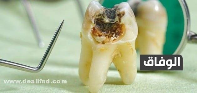 علاج ضرسي محفور ويوجعني في البيت | راحة فورية ضرسي محفور ويوجعني