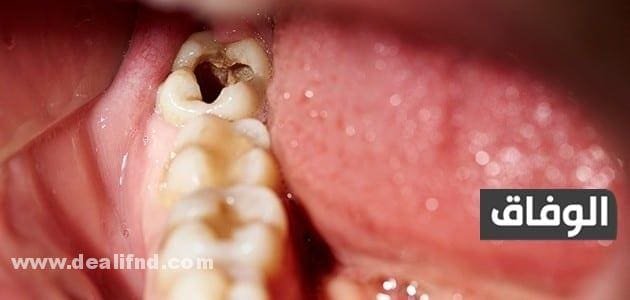علاج الضرس المحفور وأهمية هذه العمليىة في علاج الأسنان