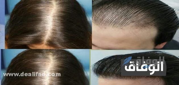 فروة رأسي تؤلمني وشعري يتساقط  علاج فروة الرأس بالاعشاب