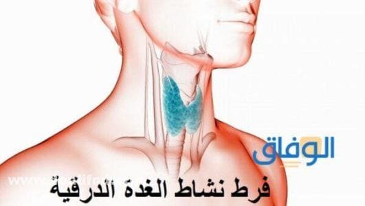 علاج فرط نشاط الغدة الدرقية بالأعشاب