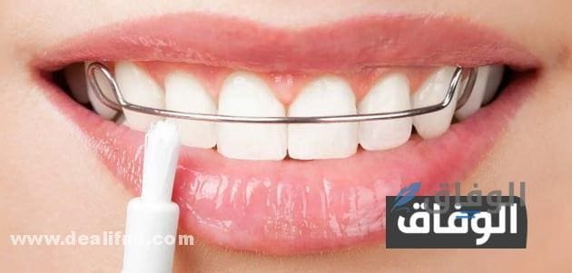 بسهولة وفعالية (كيفية تقويم الأسنان في المنزل) 03 طرق