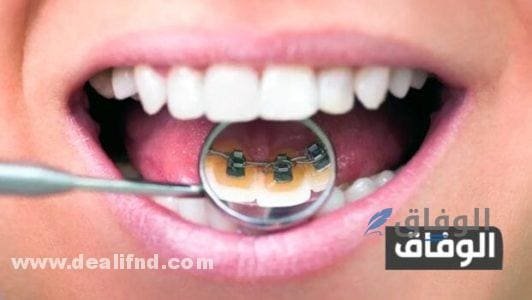 بسهولة وفعالية (كيفية تقويم الأسنان في المنزل) 03 طرق كيفية تقويم الأسنان في المنزل