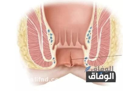 أفضل مسكن لآلام الشرخ أفضل مسكن لآلام الشرخ