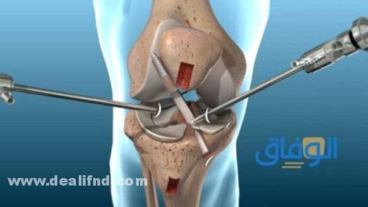 علاج قطع الرباط الصليبي الأمامي دون جراحة