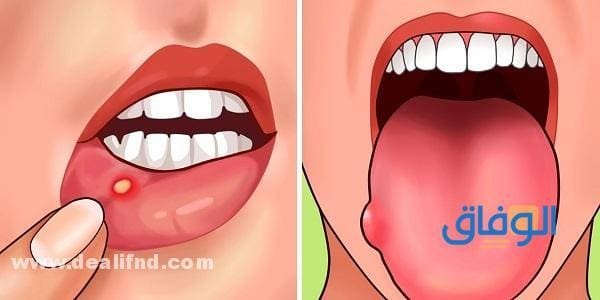 حمض الفوليك للشعر هل يسمن؟ وما هي فوائده وأعراضه نقصه في الجسم حمض الفوليك للشعر هل يسمن