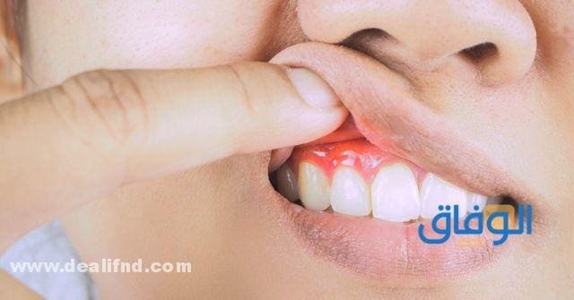 علاج التهاب اللثة وانتفاخها من الصيدلية | مُجرب ومضمون