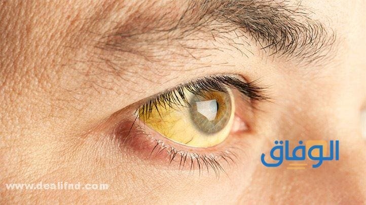 نسبة الصفراء الخطيرة عند الكبار وطرق علاجها بالأعشاب الطبيعية