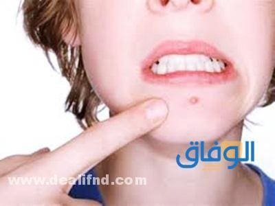 علاج الهربس – بالأعشاب/الادوية/ بالمنذل (شرح تفصيلي)