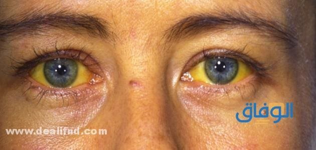 اعراض الكبد الوبائي