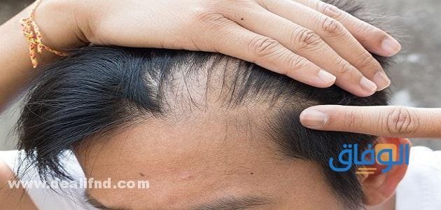 مشاكل الشعر الدهني وطرق علاجه