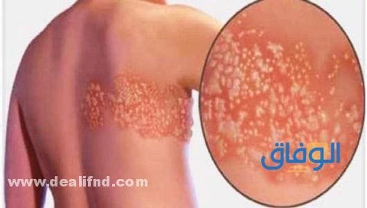 اعراض الحزام الناري - هل هو خطير ؟! اعراض الحزام الناري