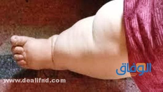 سبب مرض الفيل هي ديدان – داء الفيل