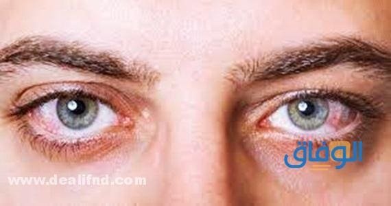 علاج ارهاق العين – أسهل 04 طرق طبيعية