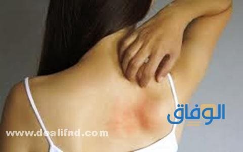 اعراض الحزام الناري – هل هو خطير ؟!