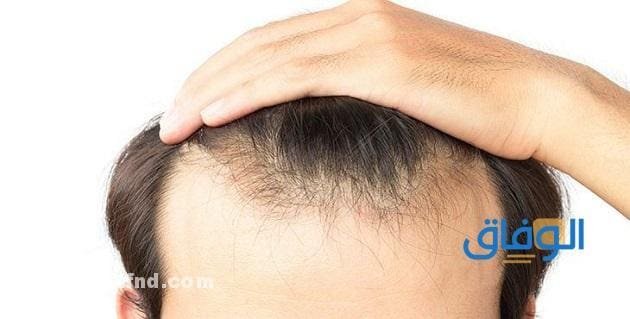 أسعار زراعة الشعر في مصر 2024 Hair Transplant