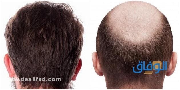 أسعار – زراعة الشعر السعودية تكلفة كم تبلغ 2024