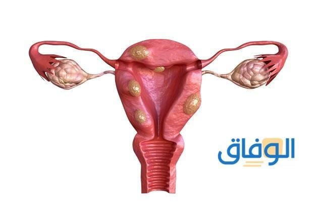 حجم الورم الليفي الطبيعي