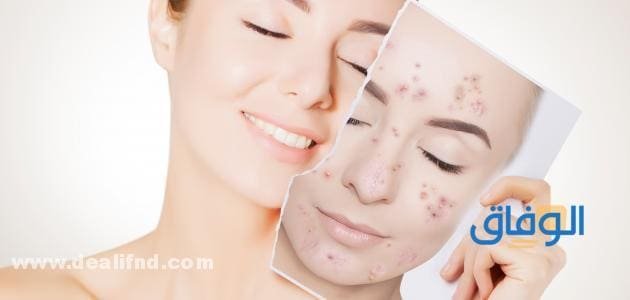 خلطة لإزالة آثار حب الشباب من أول استعمال