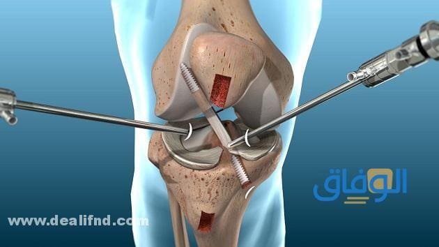 سعر عملية الرباط الصليبي في مصر 2021