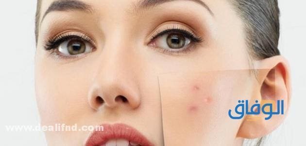 اقوي 03 (كريم لآثار الحبوب البنية) الاشهر والافضل 2024!! كريم