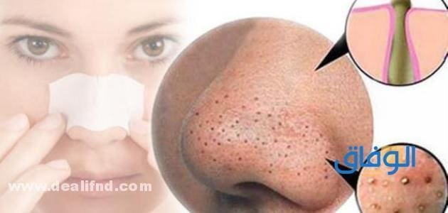 ماسك لحب الشباب والرؤوس السوداء