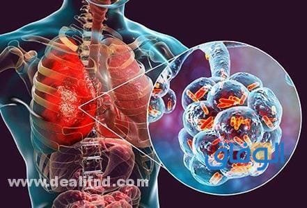 +06 (علامات تعب الرئه) الالتهاب الرئوي علامات تعب الرئه