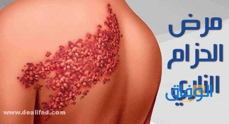أسرع طريقة لعلاج الحزام الناري (مجربة ومضمونة) 100%