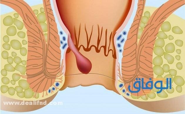 تجربتي في علاج الشرخ بـ 08 طرق فعالة!! التخلص من الشرخ