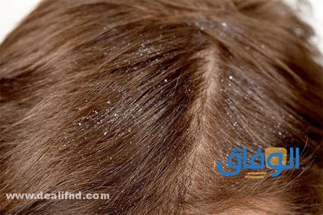 03 أفضل (شامبو ضد القشرة من الصيدلية)؟ فعال ومضمون!!