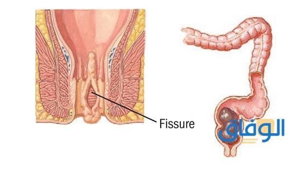 تجربتي في علاج الشرخ بـ 08 طرق فعالة!! علاج الشرخ