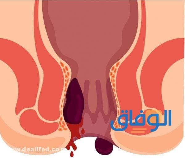 +08 (أفضل علاج للبواسير في الصيدليات) 2024