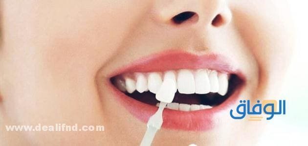 أسعار وطرق : علاج بروز الأسنان بالتلبيس!!