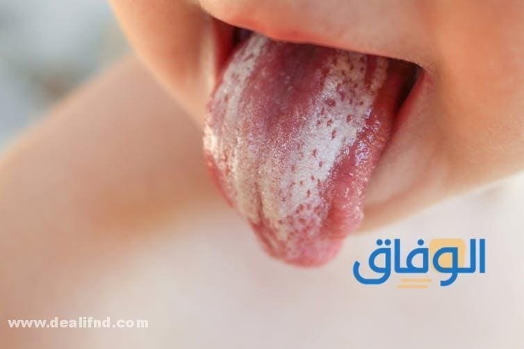 افضل 08 كريم مضاد للفطريات (فعال100%)