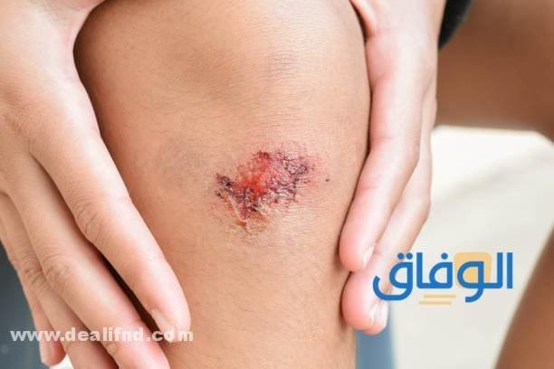 كريم مضاد حيوي للجروح