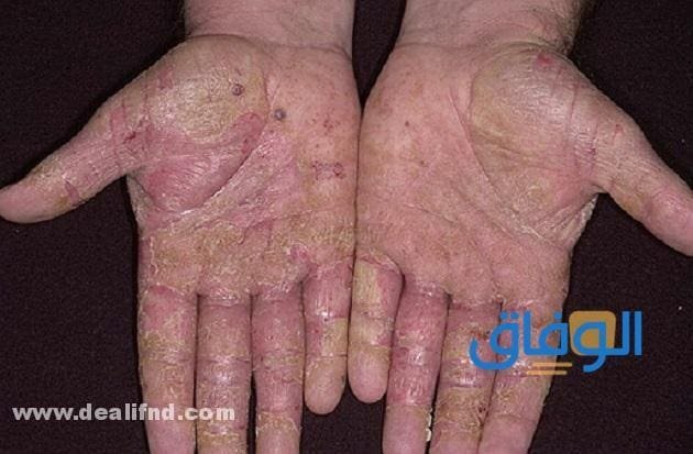 Eczema (أنواع الإكزيما) وأعراضها!! أكزيما خلل التعرق