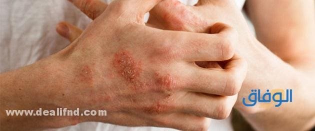 أنواع الأكزيما