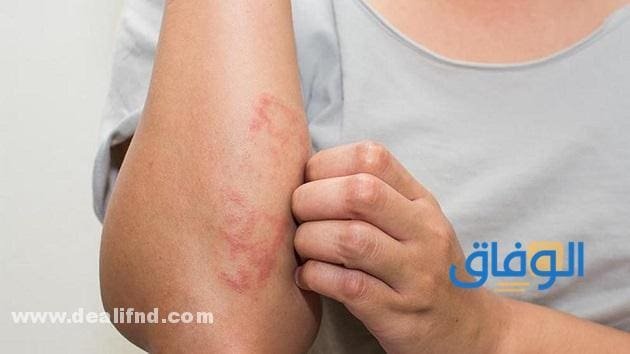Eczema (أنواع الإكزيما) وأعراضها!! .أنواع الأكزيما