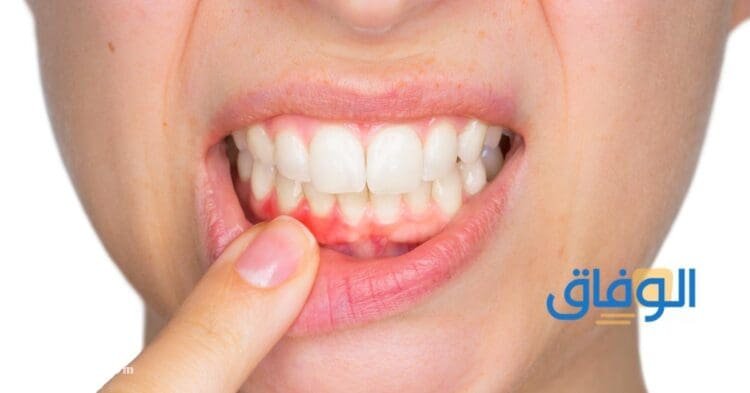 07 (أنواع التهاب اللثة بالصور) وطرق الوقاية من التهاب اللثة