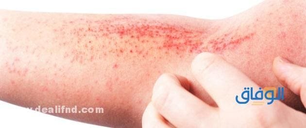Eczema (أنواع الإكزيما) وأعراضها!! التهاب الجلد التأتبي