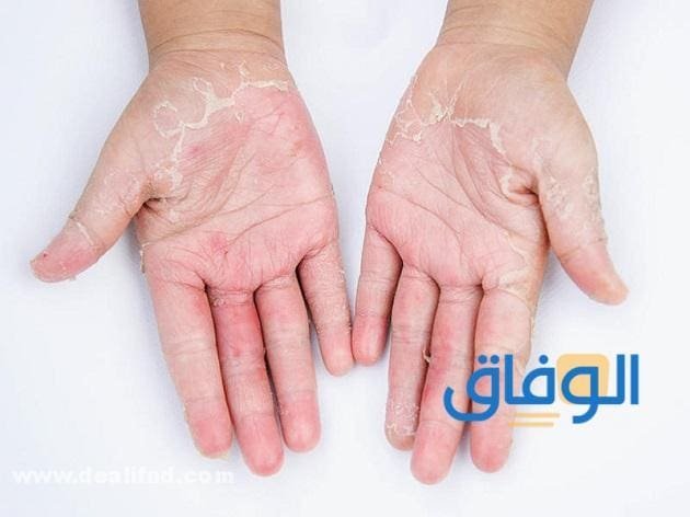 Eczema (أنواع الإكزيما) وأعراضها!! التهاب الجلد التماسي