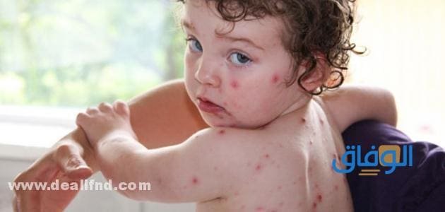 أعراض العنقز و05 طرق لعلاجه؟